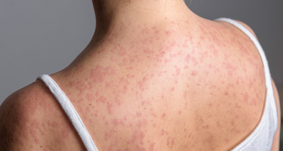 A close up image of a woman's back, covered in a measles rash.